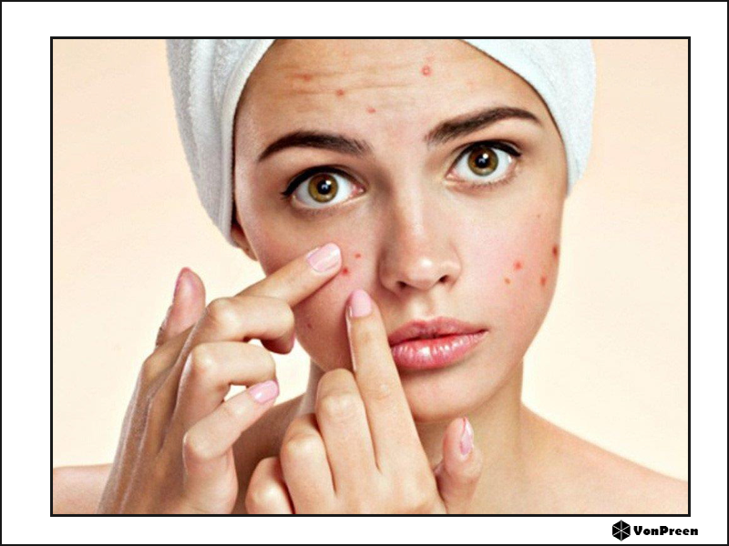 5 điều nên tránh khi chăm sóc da nhờn mụn